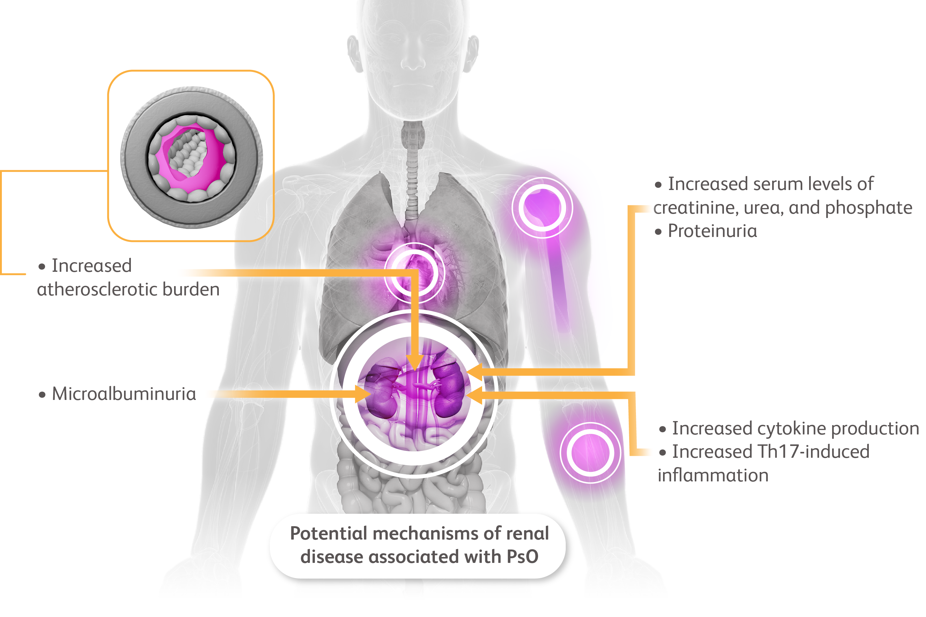 Torso with kidneys, heart, a joint, and skin highlighted to show A CKD links to other comorbidities.