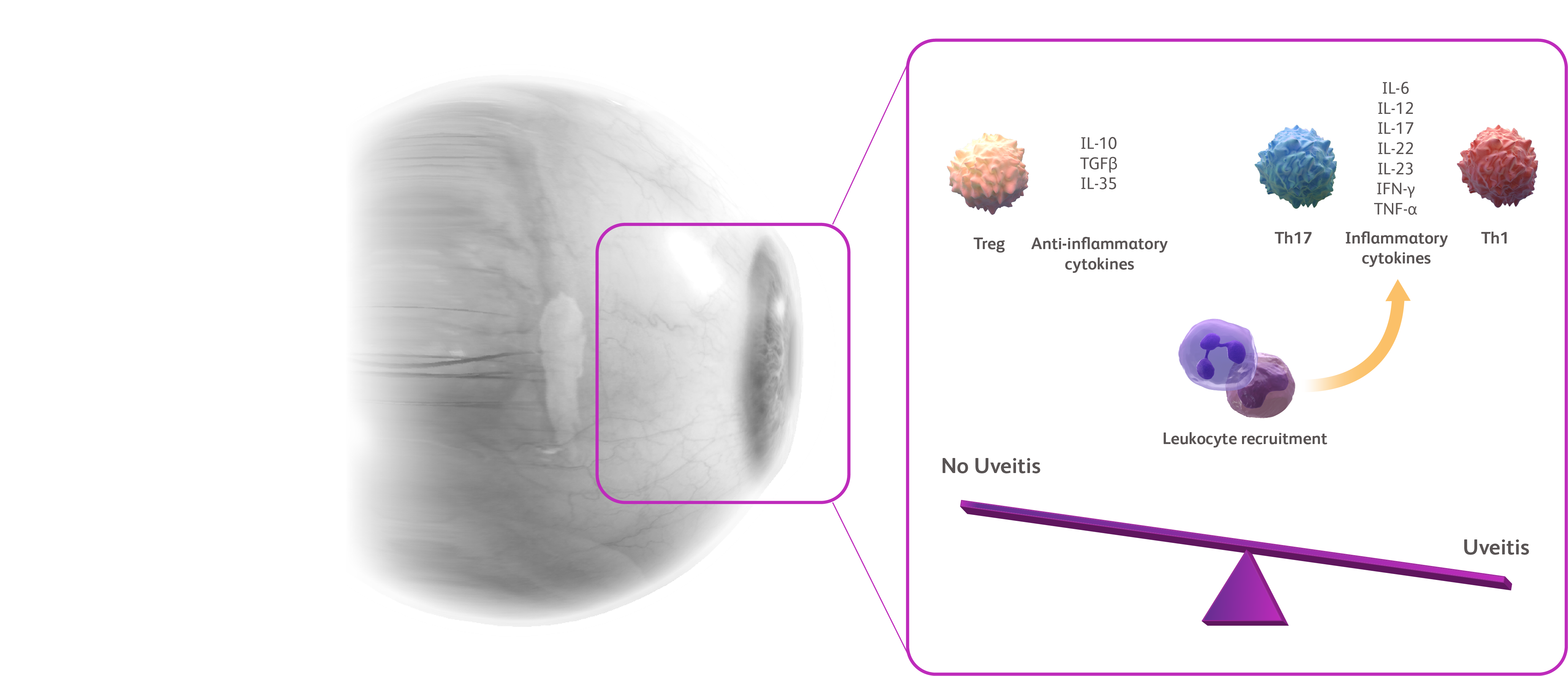 Eye with a call-out from the uvea to the signal imbalance towards inflammatory signaling fueling uveitis.